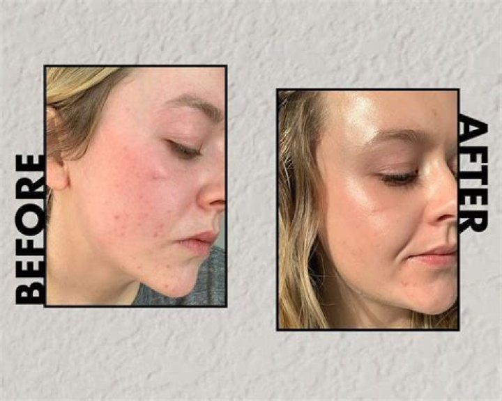 azelaic acid acne