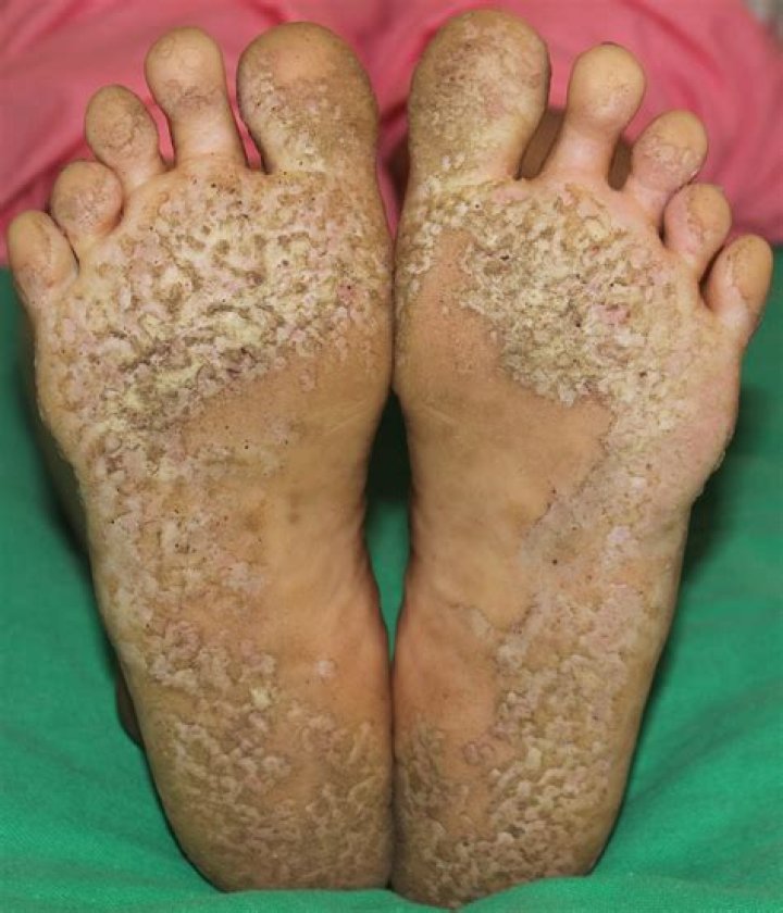 pitted skin
