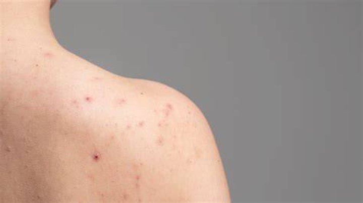 shoulder acne