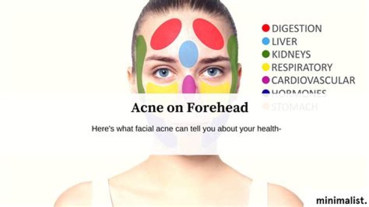 What does forehead acne mean
